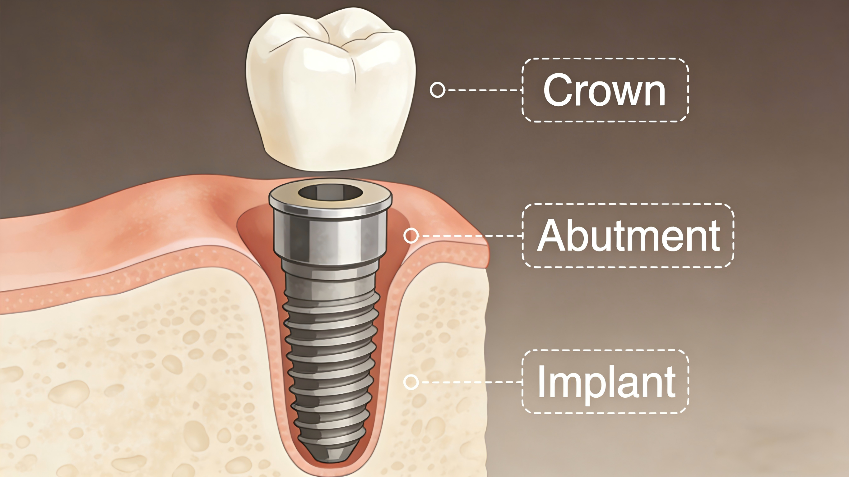 The relationship between dental implants, abutments, and crowns