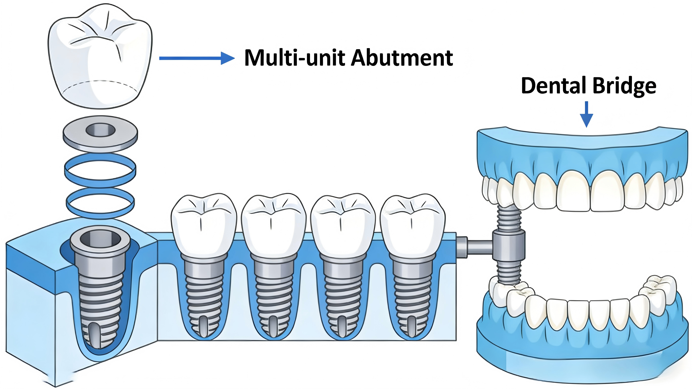 Complete Guide to Dental Implant Abutments