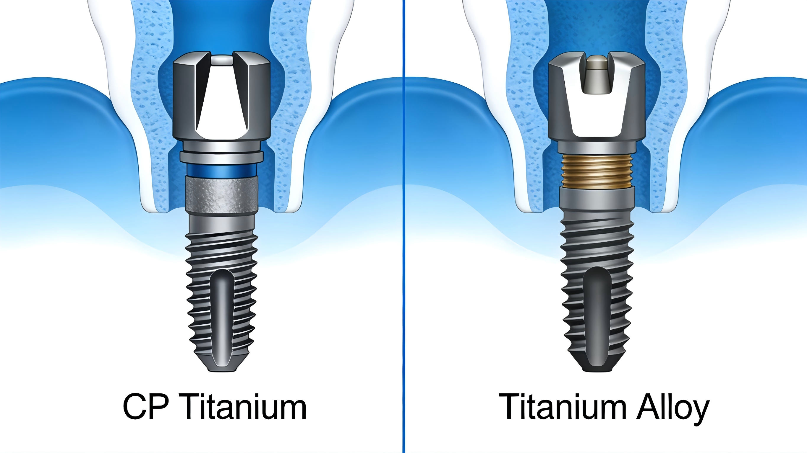Why is titanium commonly used as a material for implants?