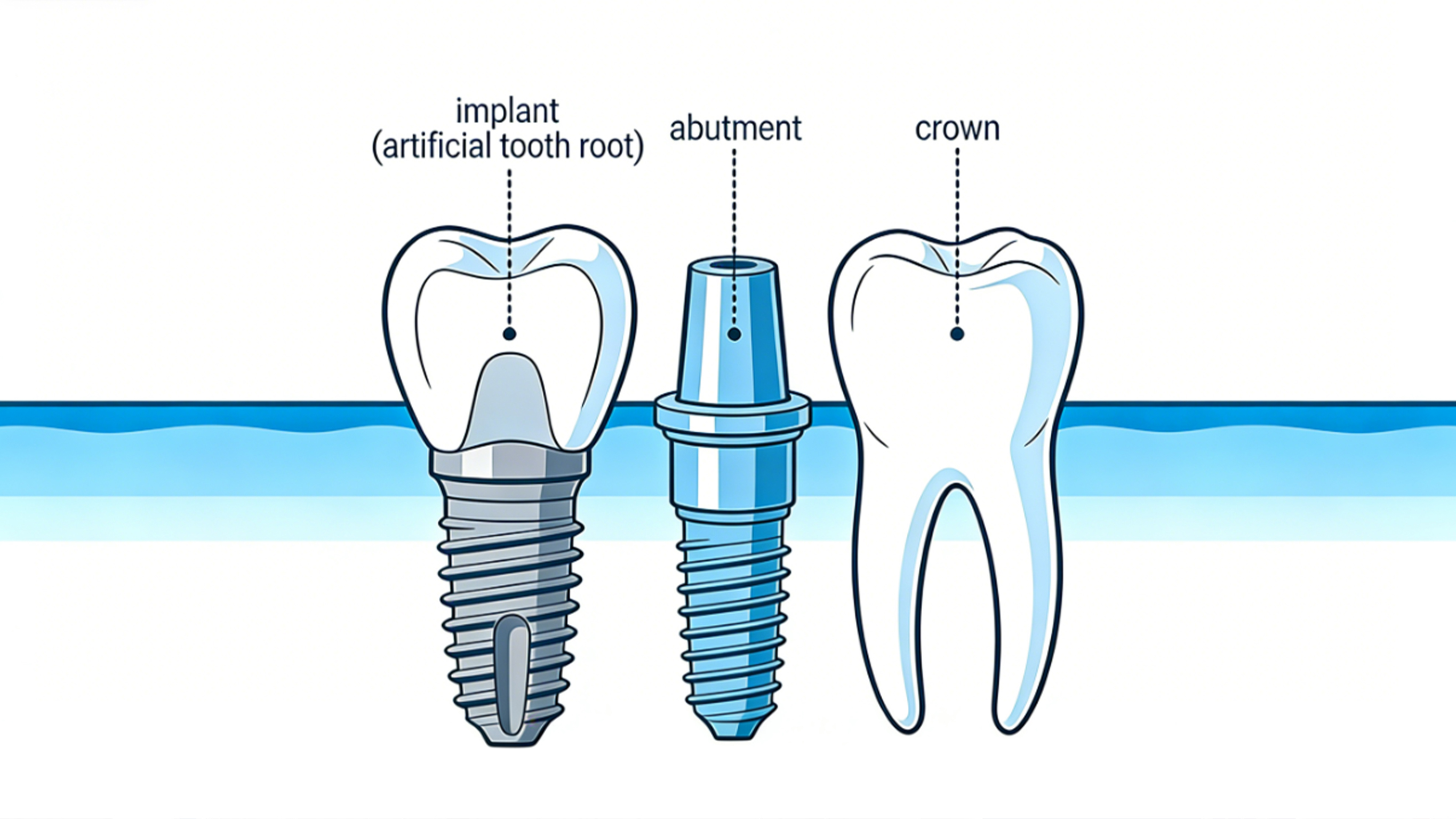 How Long Do Dental Implants Last?